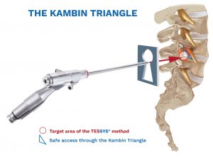 Kambin Award - ESPINEA®